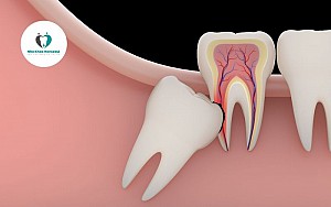 Có nên nhổ răng số 8 khi đang niềng răng?