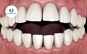 Niềng răng bị bung mắc cài phải làm sao? Hướng xử lý