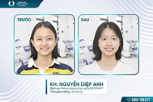 Từ ngại cười đến tự tin tỏa sáng nhờ niềng răng Biosmart