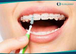 Chăm sóc răng khi niềng – Vệ sinh răng miệng đúng cách khi niềng răng
