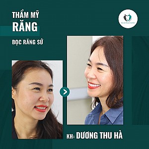 Bọc răng sứ ở đâu chất lượng tốt nhất tại quận Đống Đa, Hà Nội?