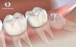 Có nên nhổ răng số 8 khi đang niềng răng?