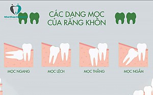 Có nên nhổ răng số 8 khi đang niềng răng?