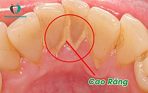 Độ tuổi nào niềng răng là tốt nhất? Có nên niềng răng sớm không?