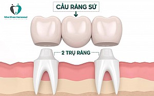 Những hậu quả bọc răng sứ giá rẻ gây ra mà bạn không ngờ tới