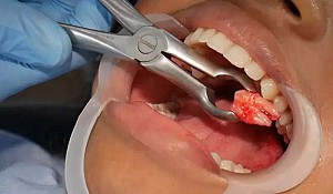 Có nên nhổ răng số 8 khi đang niềng răng?