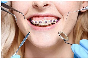 Niềng răng bị bung mắc cài phải làm sao? Hướng xử lý