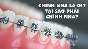 Niềng răng bị bung mắc cài phải làm sao? Hướng xử lý