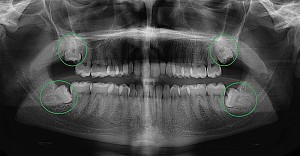 Có nên nhổ răng số 8 khi đang niềng răng?