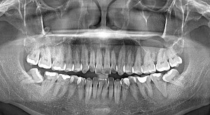 Có nên nhổ răng số 8 khi đang niềng răng?