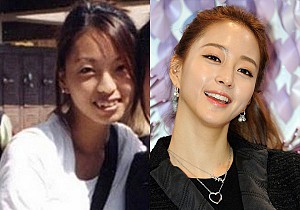 Những hậu quả bọc răng sứ giá rẻ gây ra mà bạn không ngờ tới