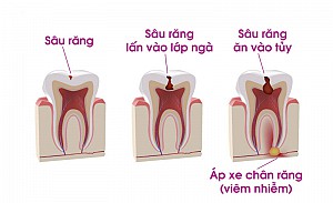 Điều trị tủy răng có lâu không? Tại sao phải điều trị tủy răng?