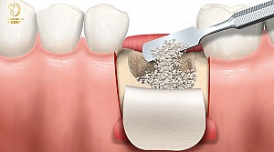 Trồng răng implant có bị hôi miệng không? Cách xử lý hiệu quả