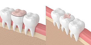 Độ tuổi nào niềng răng là tốt nhất? Có nên niềng răng sớm không?