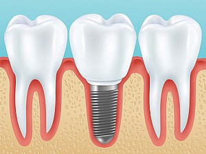 Trồng răng implant có bị hôi miệng không? Cách xử lý hiệu quả