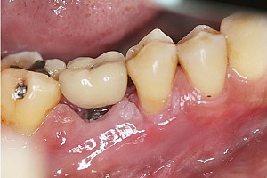 Trồng răng implant có bị hôi miệng không? Cách xử lý hiệu quả