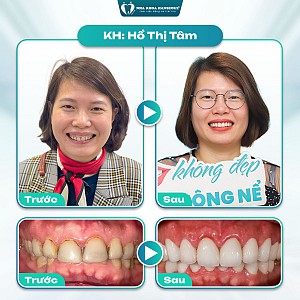 Khách hàng Nguyễn Văn Toàn cấy ghép implant All on 6