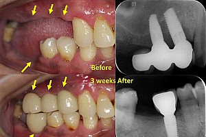 Trồng răng implant có bị hôi miệng không? Cách xử lý hiệu quả
