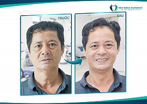 Trồng răng Implant toàn hàm – Giải pháp phục hình vượt trội