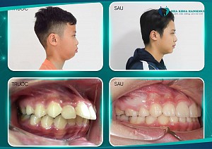 Có cần nhổ răng khi niềng không?