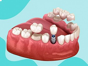 Trồng răng implant có bị hôi miệng không? Cách xử lý hiệu quả