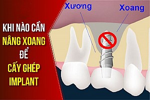 Trồng răng implant có bị hôi miệng không? Cách xử lý hiệu quả