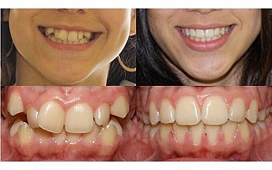 Độ tuổi nào niềng răng là tốt nhất? Có nên niềng răng sớm không?