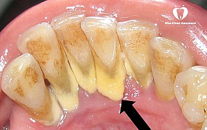 Độ tuổi nào niềng răng là tốt nhất? Có nên niềng răng sớm không?