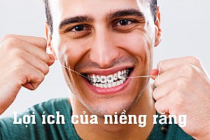 Niềng răng bị bung mắc cài phải làm sao? Hướng xử lý