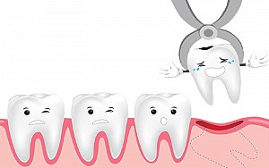 Có nên nhổ răng số 8 khi đang niềng răng?