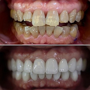 Những hậu quả bọc răng sứ giá rẻ gây ra mà bạn không ngờ tới