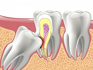 Độ tuổi nào niềng răng là tốt nhất? Có nên niềng răng sớm không?