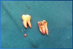 Có nên nhổ răng số 8 khi đang niềng răng?