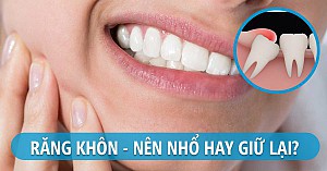 Có nên nhổ răng số 8 khi đang niềng răng?