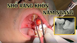 Có nên nhổ răng số 8 khi đang niềng răng?