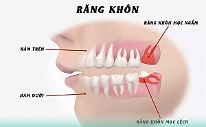 Có nên nhổ răng số 8 khi đang niềng răng?