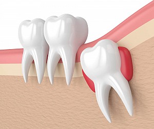 Có nên nhổ răng số 8 khi đang niềng răng?