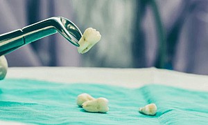 Có nên nhổ răng số 8 khi đang niềng răng?