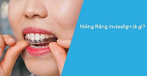 Niềng răng bị bung mắc cài phải làm sao? Hướng xử lý
