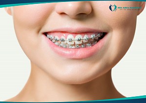 Niềng răng mất bao lâu? Các giai đoạn và thời gian điều trị