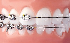 Niềng răng bị bung mắc cài phải làm sao? Hướng xử lý