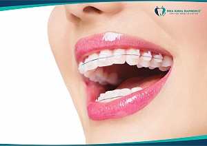 Niềng răng bị bung mắc cài phải làm sao? Hướng xử lý