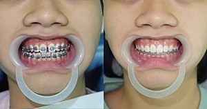 Niềng răng bị bung mắc cài phải làm sao? Hướng xử lý