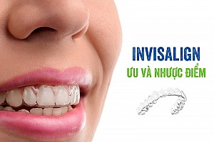 Niềng răng bị bung mắc cài phải làm sao? Hướng xử lý