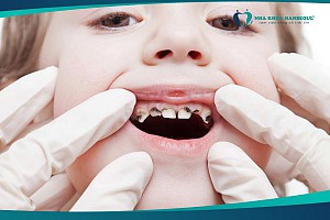 Top 8 thuốc xịt chống sâu răng tốt nhất trên thị trường hiện nay