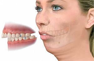 Niềng răng bị bung mắc cài phải làm sao? Hướng xử lý