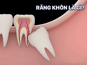Có nên nhổ răng số 8 khi đang niềng răng?