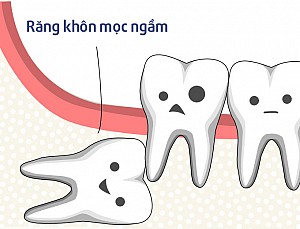 Có nên nhổ răng số 8 khi đang niềng răng?
