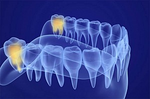 Có nên nhổ răng số 8 khi đang niềng răng?
