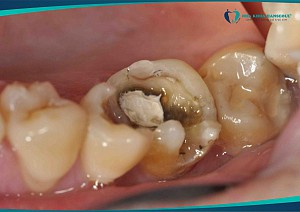 Tác hại của răng số 8 và lời khuyên từ chuyên gia Hanseoul